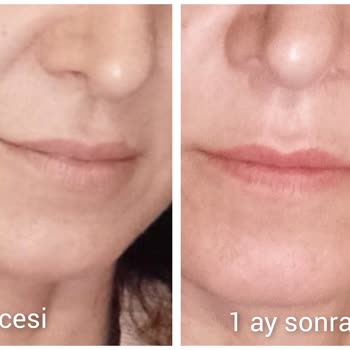 Tanfer Estetik Dudak Dolgu İşlemi!