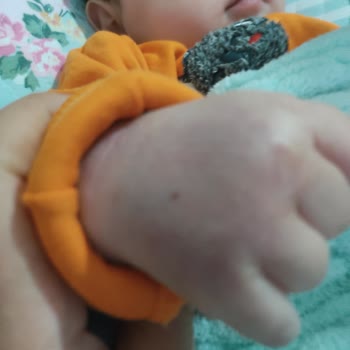 Anadolu Hastanesi (Kastamonu) Çocuğumun Kolunun Şişmesi