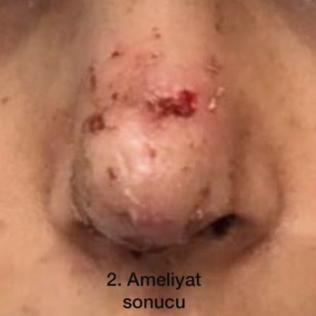 Burun Estetiği Yeni İklim Hastanesi