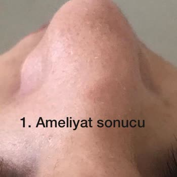 Burun Estetiği Yeni İklim Hastanesi