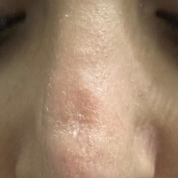 Burun Estetiği Yeni İklim Hastanesi