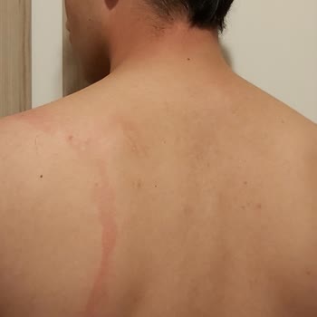 Sebamed Şampuan Alerji Yaptı