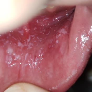 Oral - B Diş Macunu Diş Eti Damağımı Yara Yaptı