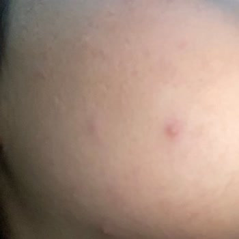 Yves Rocher Memnun Kalmadım Sivilce Çıktı Yüzümde