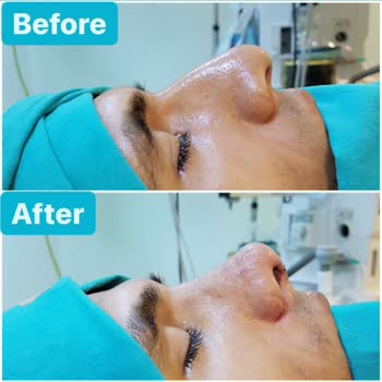 A Life Hospital Burun Estetiği Ameliyatı Sonrası Yaşadığım Sorunlar