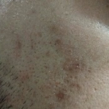 Garnier Bha Aha Serum Alerjisi