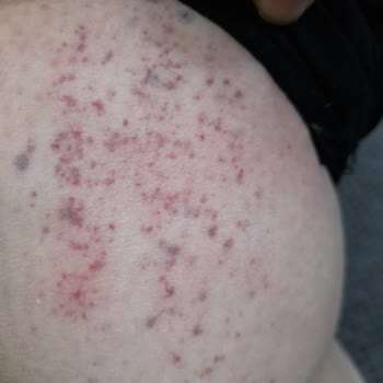 Dilan Polat Estetik Lazer Ve Bölgesel İncelme Sorunu