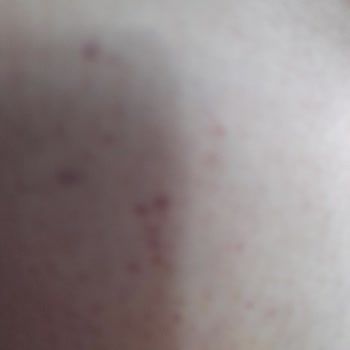 Dilan Polat Estetik Lazer Ve Bölgesel İncelme Sorunu