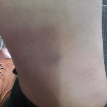 Dilan Polat Estetik Lazer Ve Bölgesel İncelme Sorunu