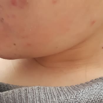 Abdi İbrahim Hametan Sarı Krem Kızarıklık Yaptı