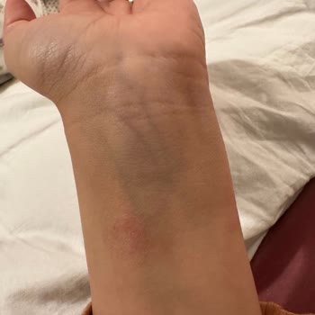 Apple Watch 8 S Bileğimi Yaktı