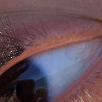 Funda Ak Epilasyon Güzellik İpek Kirpikte Kötüydü