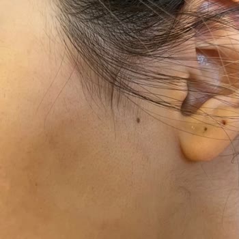 Philips Lumea IPL Cihazı Yüzümde Egzamaya Neden Oldu