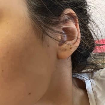 Philips Lumea IPL Cihazı Yüzümde Egzamaya Neden Oldu