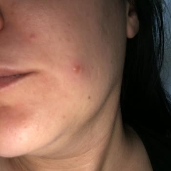 La Roche - Posay Güneş Kremi Sivilce Yaptı