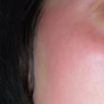 Dermokil Hyaluronik Asit Serum Kağıt Maske Yüzümü Yaktı