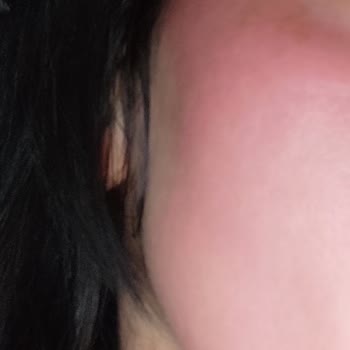 Dermokil Hyaluronik Asit Serum Kağıt Maske Yüzümü Yaktı