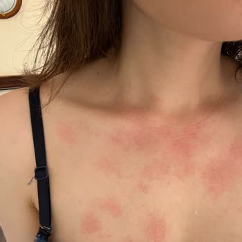 Johnson's Baby Şampuan Alerjisi