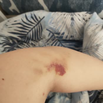 Özel Hekimler Cerrahi Tıp Merkezi Özel Hekimler Hastanesi Kan Alımı