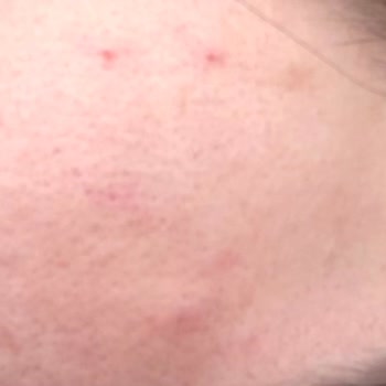 Gratis Beaulis Marka Fondöten Kullanımı Sonrası Ciltte Çıban Ve Sivilce Oluşumu