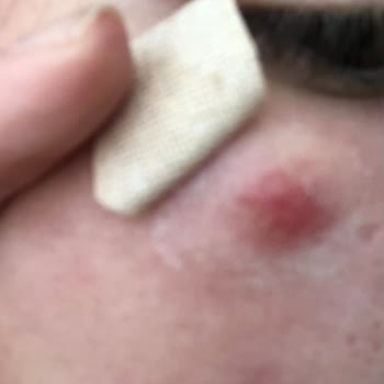 Gratis Beaulis Marka Fondöten Kullanımı Sonrası Ciltte Çıban Ve Sivilce Oluşumu