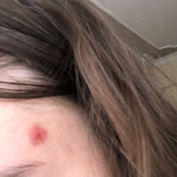 Gratis Beaulis Marka Fondöten Kullanımı Sonrası Ciltte Çıban Ve Sivilce Oluşumu