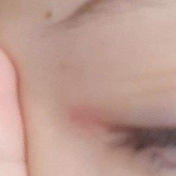 SHE Vec Serumum Bozuk Geldi Ve Göz Çevremde Tahrişlere Sebep Oldu