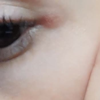 SHE Vec Serumum Bozuk Geldi Ve Göz Çevremde Tahrişlere Sebep Oldu