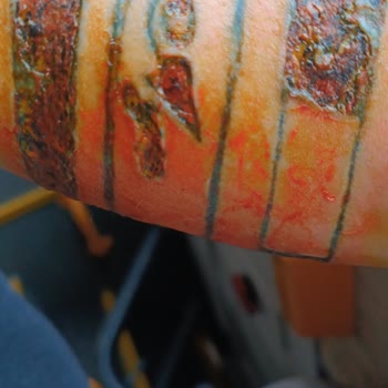 Sandra Güzellik Ve Epilasyon Salonu Dövme Silme İşlemi Sonucunda Oluşan Yanıklar Göçükler