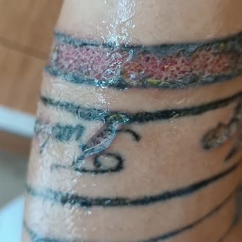 Sandra Güzellik Ve Epilasyon Salonu Dövme Silme İşlemi Sonucunda Oluşan Yanıklar Göçükler