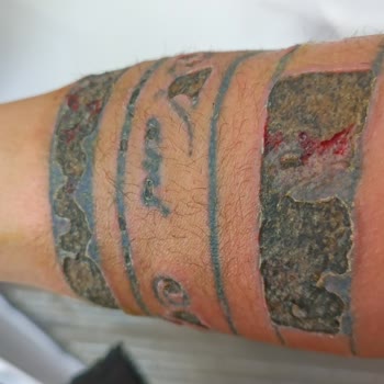 Sandra Güzellik Ve Epilasyon Salonu Dövme Silme İşlemi Sonucunda Oluşan Yanıklar Göçükler