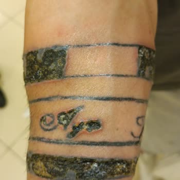 Sandra Güzellik Ve Epilasyon Salonu Dövme Silme İşlemi Sonucunda Oluşan Yanıklar Göçükler