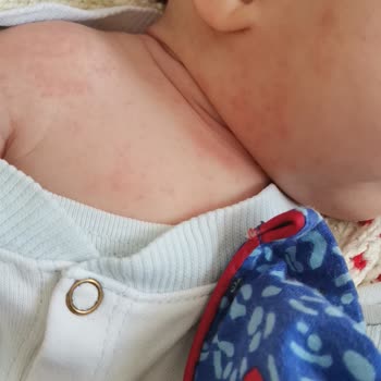 Dalin Bebek Yağının Tahriş Etmesi