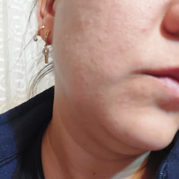 The Purest Solutions Sarı Tonik Yüzümü Yaktı!