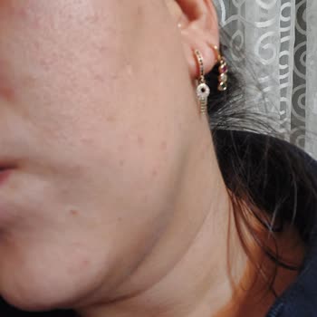 The Purest Solutions Sarı Tonik Yüzümü Yaktı!