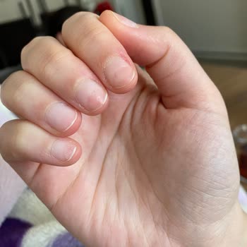 Narges Beauty Center'de Protez Tırnak Çıkartma İşleminde Tırnak Hasarı