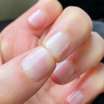 Narges Beauty Center'de Protez Tırnak Çıkartma İşleminde Tırnak Hasarı