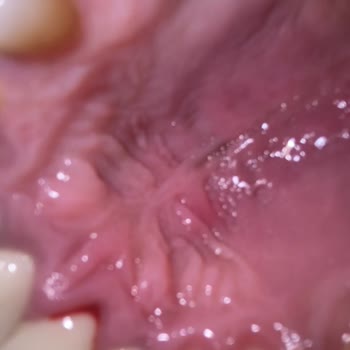 Listerine Ağızda Yara Damakta İltihap