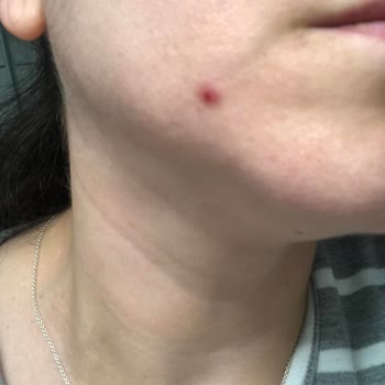 Bioderma Pigmentbio Night Renewer, Daily Care+50 Sivilce Leke Yaptı