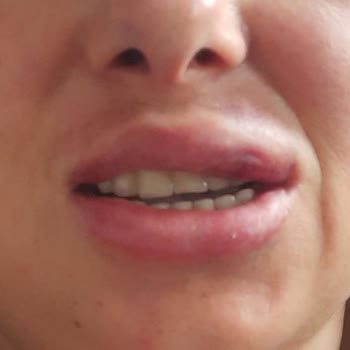 Sade Derma Estetik 'te Yanlış Bölgeye Yapılan Dudak Dolgusu