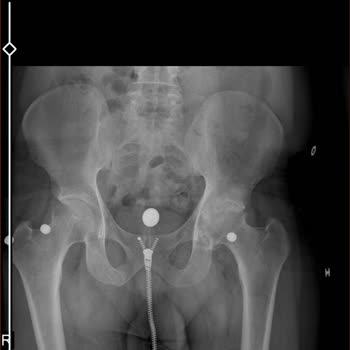 Metin Sabancı Baltalimanı Kemik Hastalıkları Eğitim ve Araştırma Hastanesi Ameliyat Sırası Beklemesi 3 Yıl Oldu