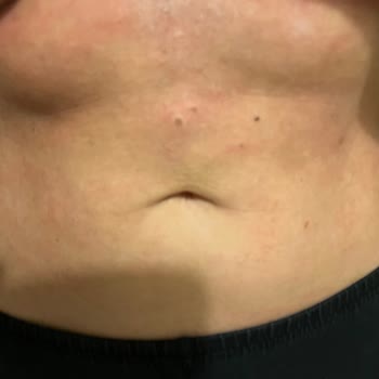 Remove Tüy Sarartıcı Krem Yanık Ve Leke Yaptı!