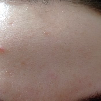 Procsin C Vitamini Cilt Tahrişi Yaptı