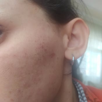 Aden Vip Güzellik Merkezi Amasya Dermapen Tedavisi Aldım Ama Sonuç Alamadım