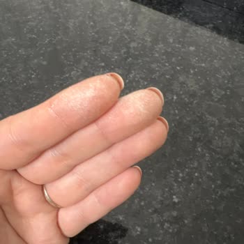 Kosla Leke Çıkarıcı Elime Zarar Verdi Elimi Yaktı