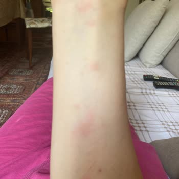 Velavit Alerji Ve Kaşıntı Şikayeti