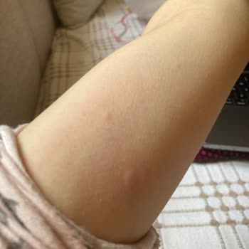 Velavit Alerji Ve Kaşıntı Şikayeti