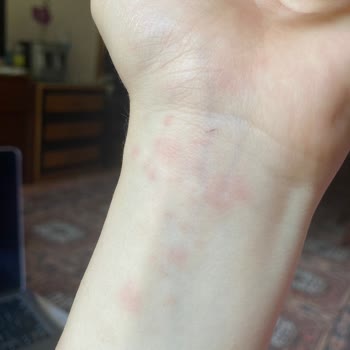 Velavit Alerji Ve Kaşıntı Şikayeti