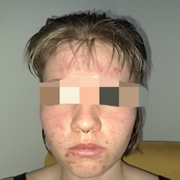 Avene Yüzümü Mahvetti, Her Yerimde Sivilce Ve İltihap Çıktı