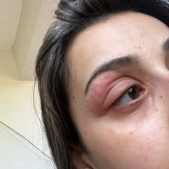 Mov Turkey Glitter Alerjisi